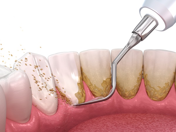 Periodontal Disease Treatment with a Holistic Dentist
