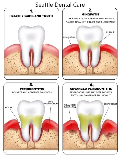 Improving Periodontal Disease with Ozone Therapy
