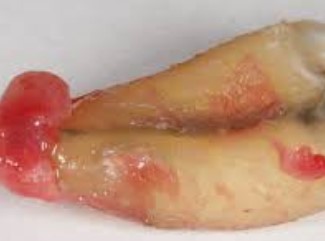 The Hidden Risks of Root Canal Therapy