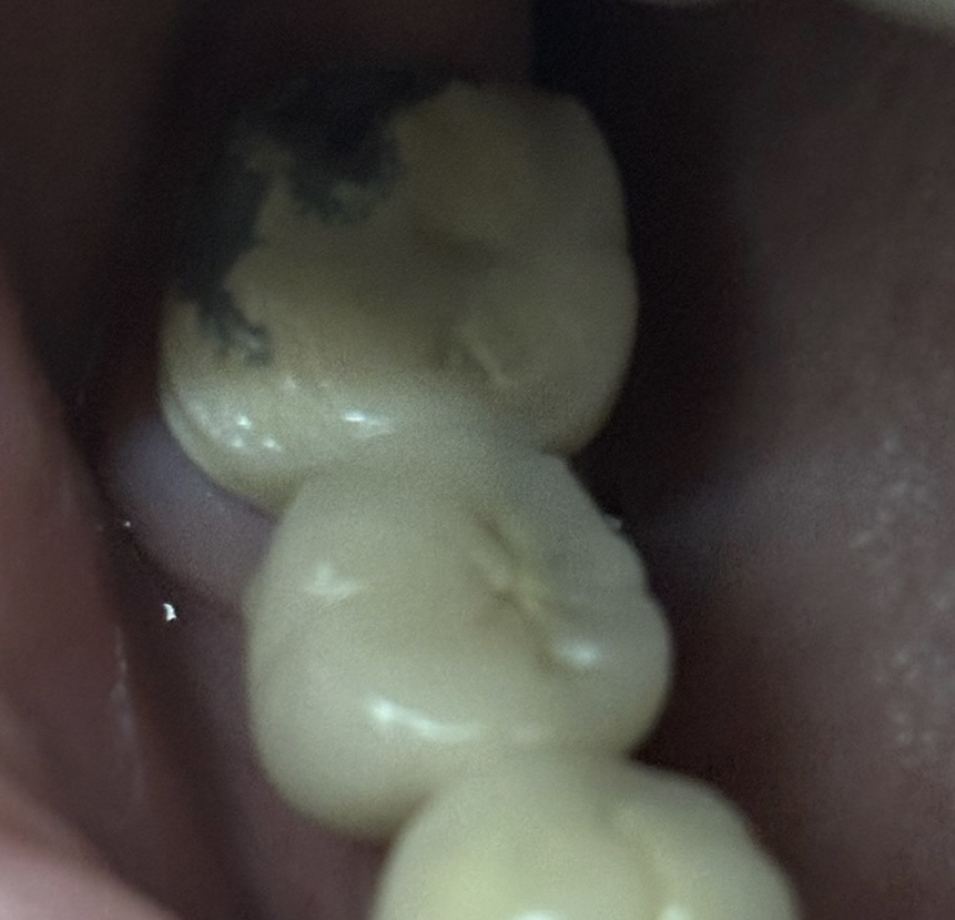 The Hidden Dangers of Porcelain-Fused-to-Metal Crowns