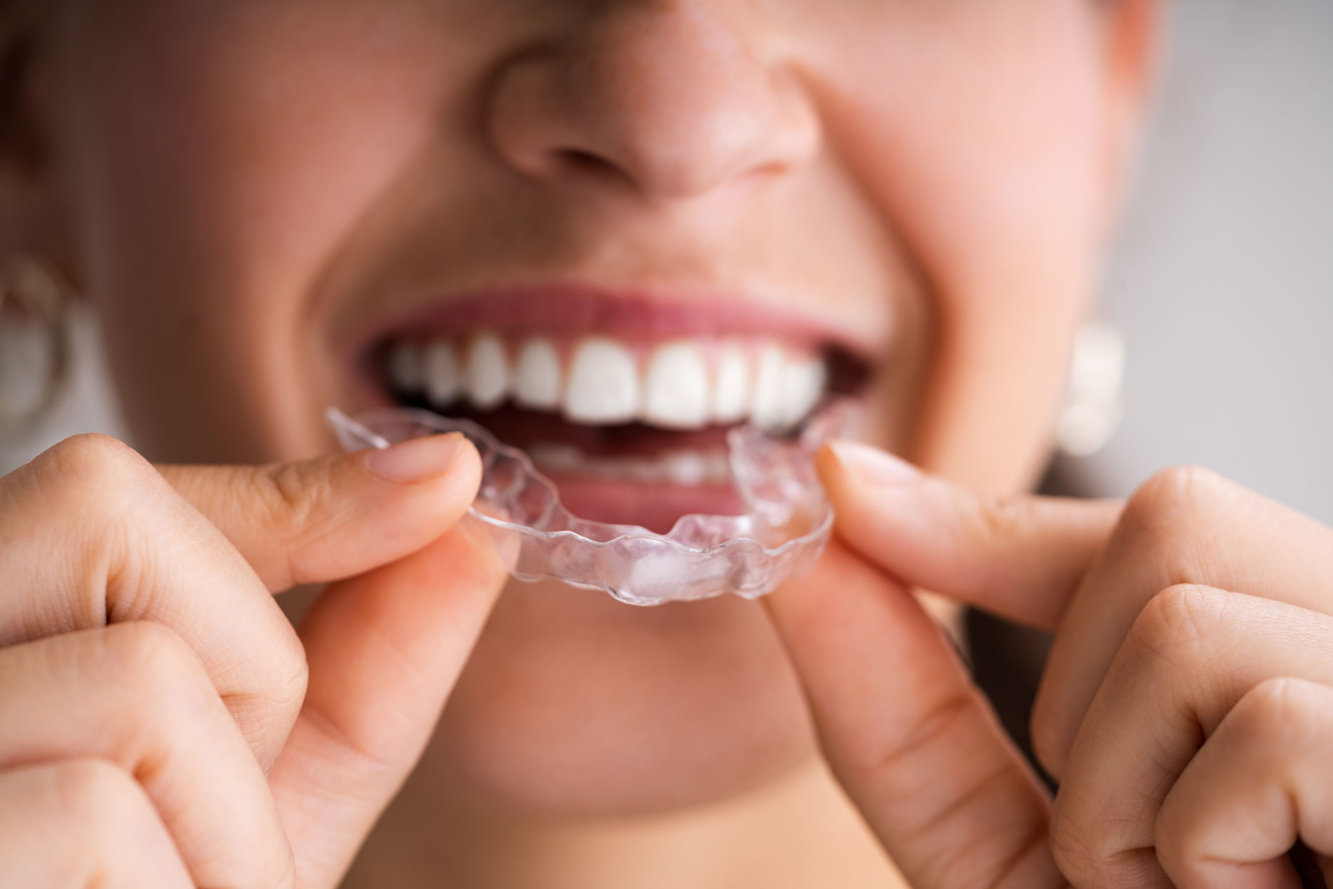 Revolutionizing Orthodontics with Biological Clear Aligners in Seattle, WA