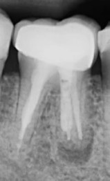 How a Root Canal Can Become Reinfected?
