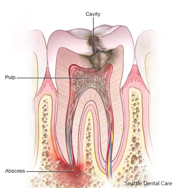 Alternative to Root Canal  in Seattle, WA