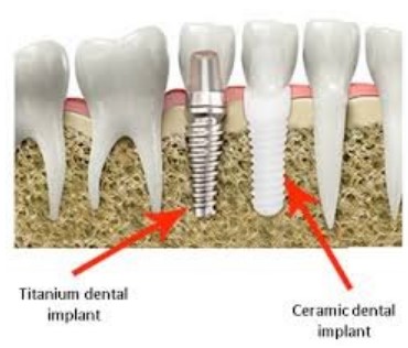 Risks of Titanium Implant