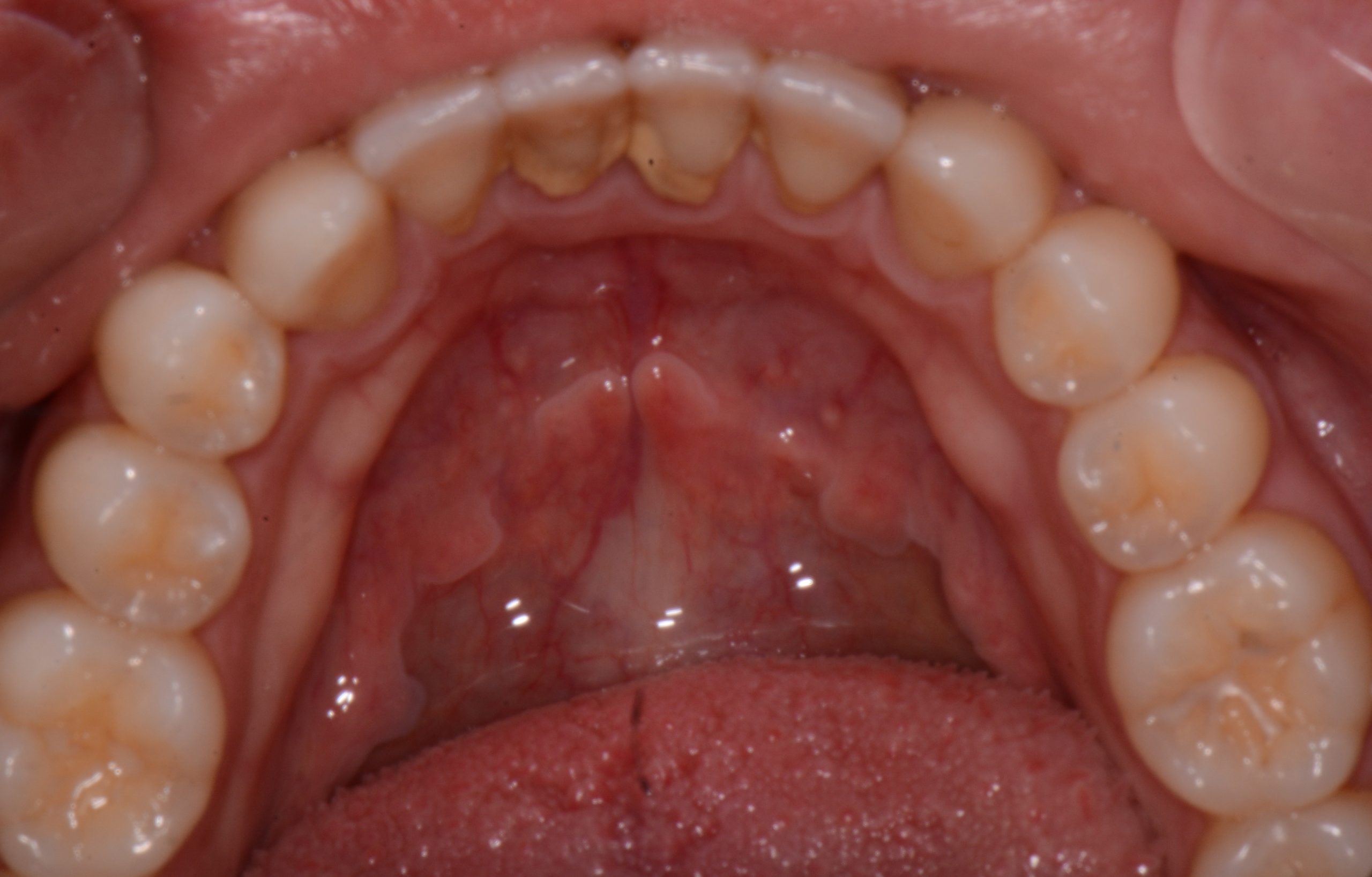 How to Treat Gum Disease