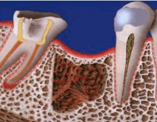 The Hidden Infection in Your Jawbone – Cavitation
