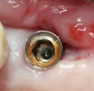 6 Warning Signs for Titanium Implant Allergy