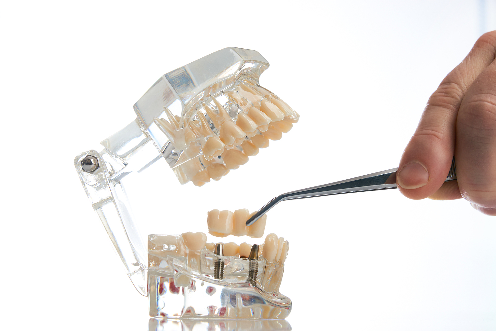 Proper Implant Placement Matters More Than Most Patients Realize