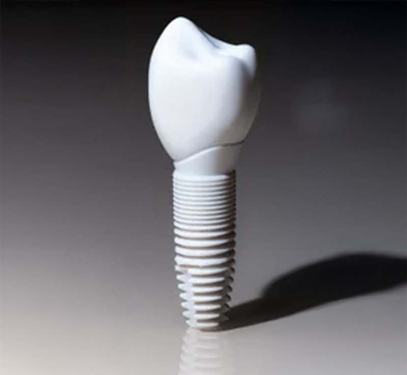 Zirconia Implants: A Modern Biological Approach to Tooth Replacement