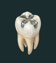 Amalgam Removal