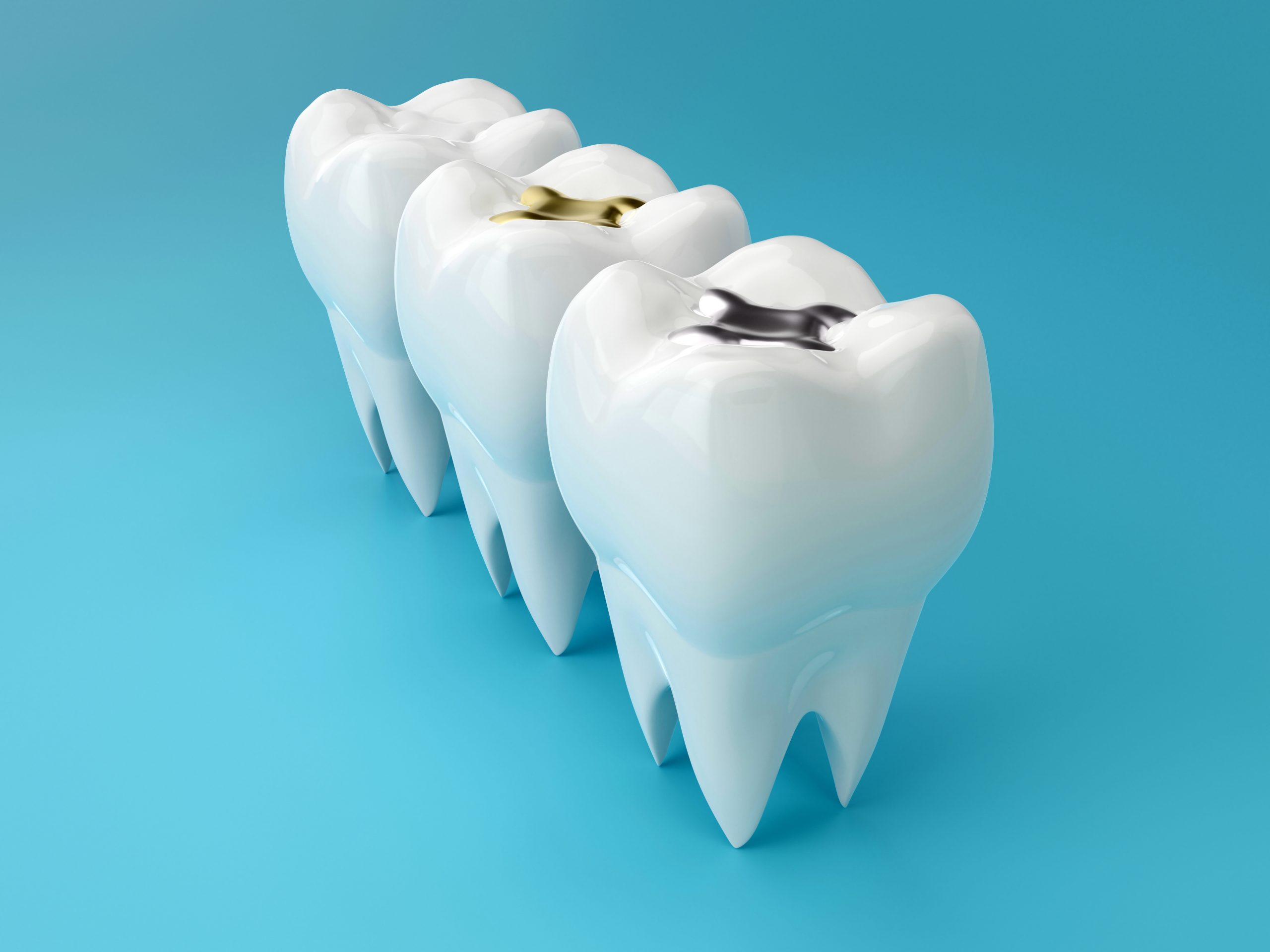 The Dark Side of “Silver Fillings”: What Patients Should Know