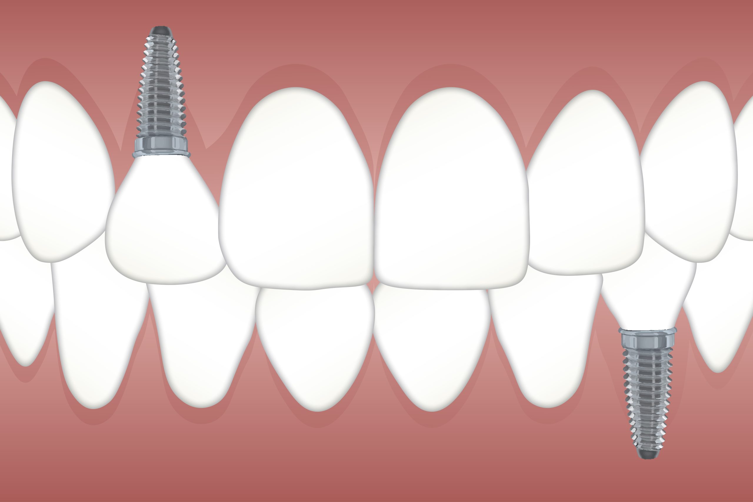 Could Your Titanium Dental Implant Be Contributing to Inflammation?