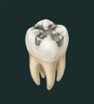 Amalgam Removal