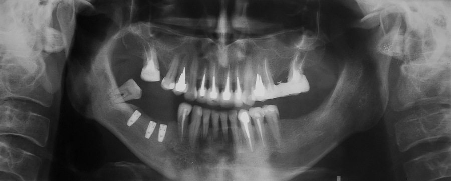 The Hidden Source of Chronic Inflammation: Jawbone Cavitations