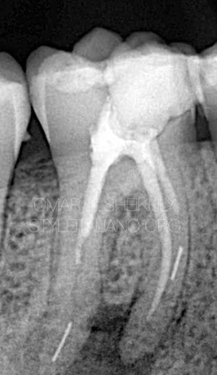 5 Persistent Root Canal Infection Symptoms